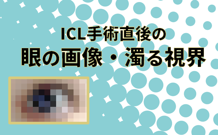 体験談 Icl手術直後の目の状態 画像あり